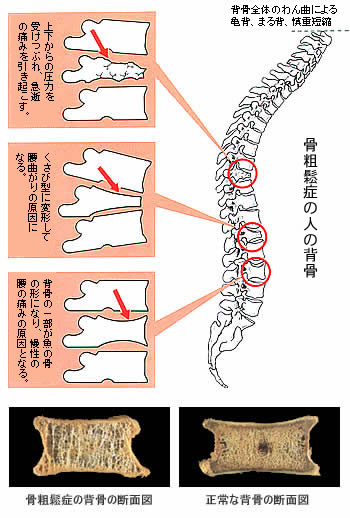 骨粗しょう症について 大阪府交野市にある 山本整形外科